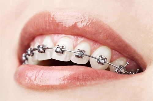 ORTHODONTIE DRS CASTELLI Alicia et MARCELLESI MarieNoëlle